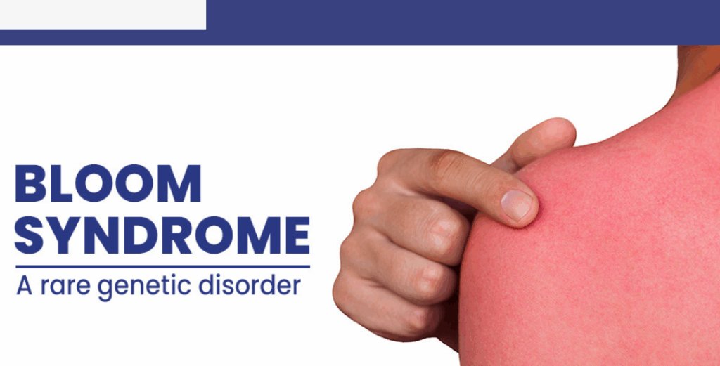 What Is Bloom Syndrome and How It Affects Health 